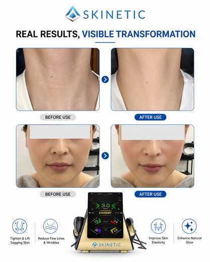 22D MAX HIFU Skin Tightening & Face Lifting Machine